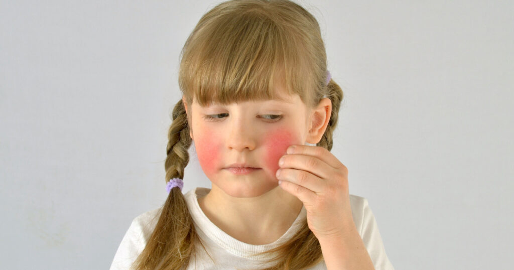 頌缽紅斑性狼瘡